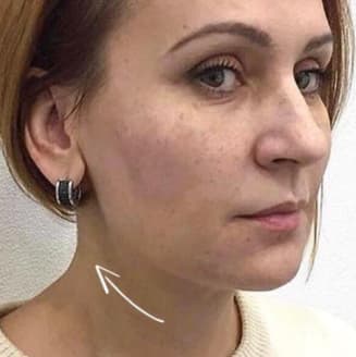 Жінка після процедури
