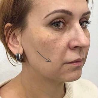 Жінка до процедури